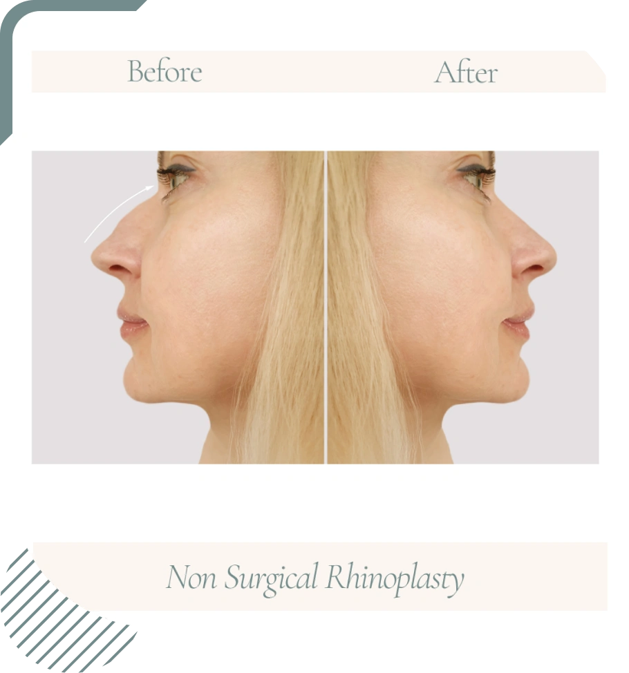 Non-Surgical-Rhinoplasty