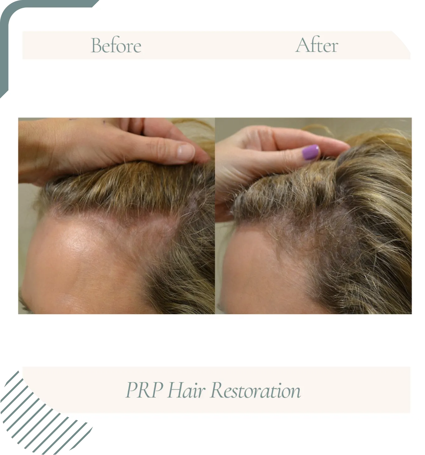 PRP-Hair-candidate